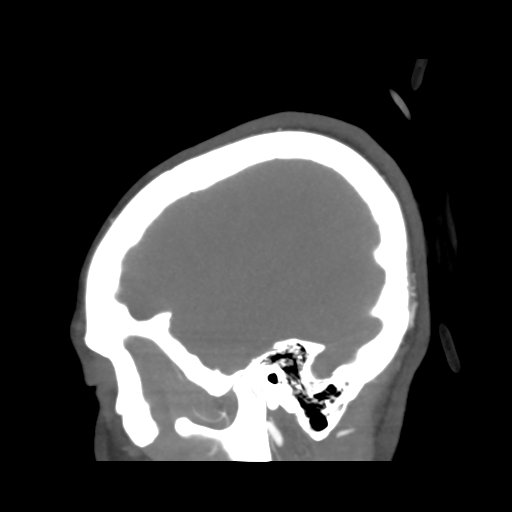 Colloid cyst (resulting in death) (Radiopaedia 33423-34499 B 48).png