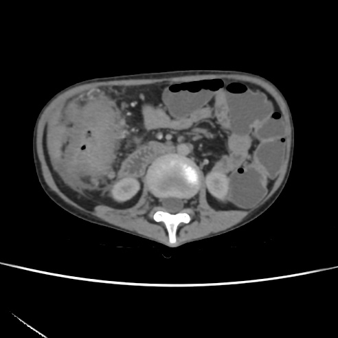 File:Colocolic fistula - Crohn disease (Radiopaedia 57063-63955 A 35).jpg