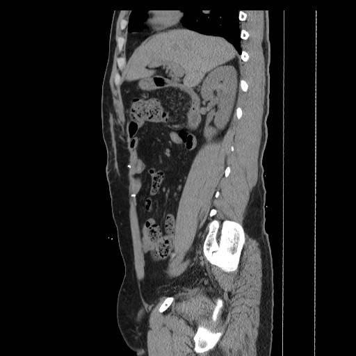 File:Colocutaneous fistula in Crohn's disease (Radiopaedia 29586-30093 C 12).jpg