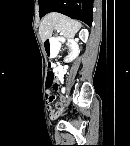 File:Colon adenocarcinoma - hepatic flexure (Radiopaedia 85635-101395 D 29).jpg
