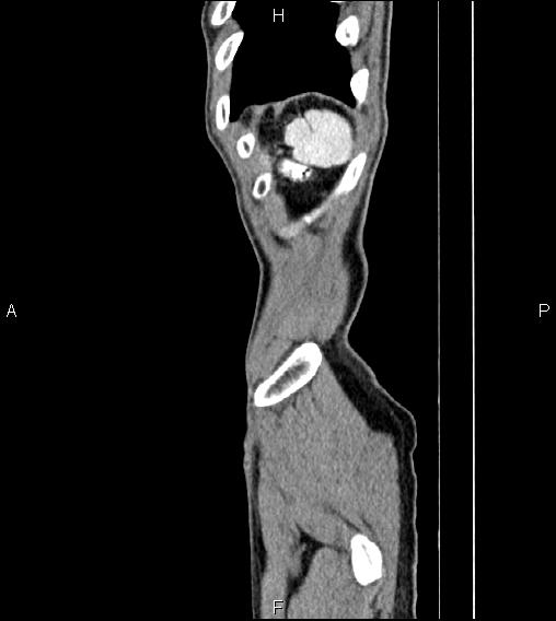 Colon adenocarcinoma - hepatic flexure (Radiopaedia 85635-101395 D 87).jpg