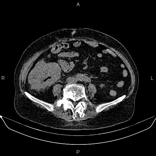 File:Colon cancer (Radiopaedia 90215-107432 Axial non-contrast 57).jpg
