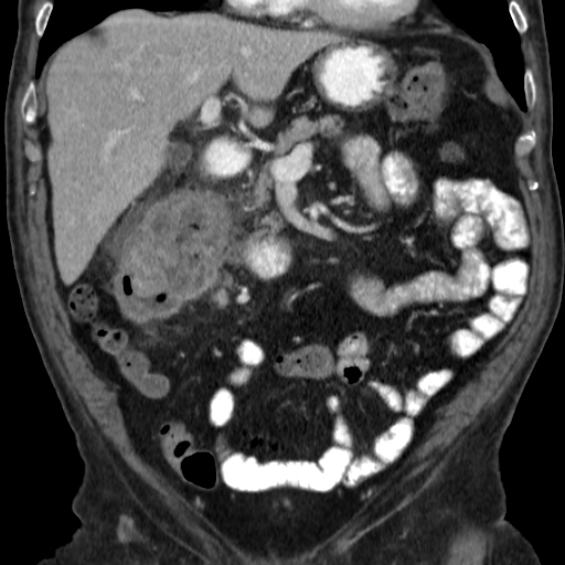 File:Colon cancer with duodenal invasion (Radiopaedia 16278-15958 B 23).jpg