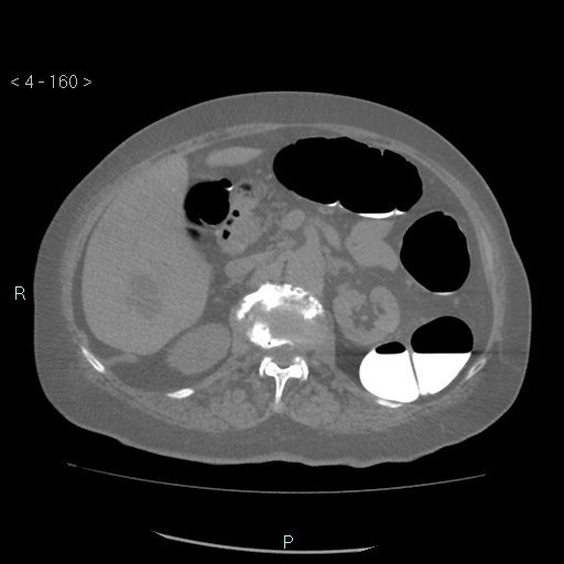 File:Colonic lipomas (Radiopaedia 49137-54244 Axial bone window 72).jpg