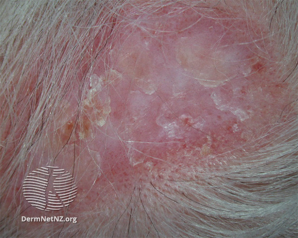 Cutaneous lupus erythematosus (DermNet NZ immune-lupus-erythematosus-2560).jpg