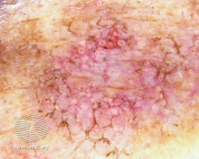 File:Dermoscopy of pigmented actinic keratosis (DermNet NZ pigmented-actinic-keratosis-5).jpg