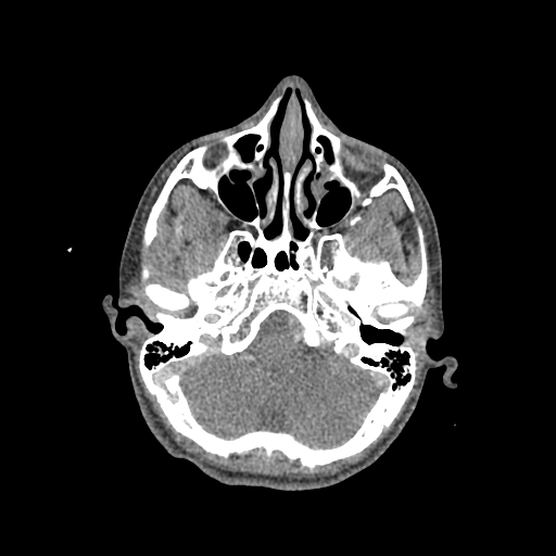 Nasal pyogenic granuloma (lobular capillary hemangioma) (Radiopaedia 85536-101244 C 82).jpg