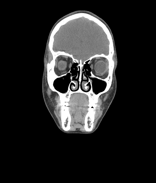 File:Nasal pyogenic granuloma (lobular capillary hemangioma) (Radiopaedia 85536-101244 Coronal non-contrast 73).jpg