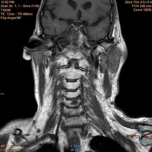 File:Nasopharyngeal carcinoma (Radiopaedia 22375-22403 Coronal T1 12).jpg