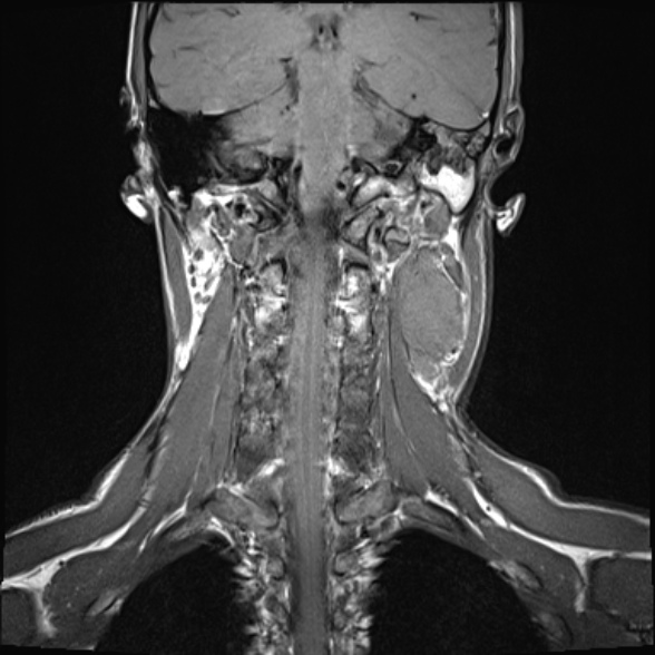 Nasopharyngeal carcinoma with skull base invasion (Radiopaedia 53415-59485 Coronal T1 9).jpg