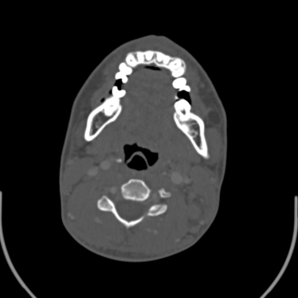 File:Nasopharyngeal carcinoma with skull base invasion (Radiopaedia 53415-59705 Axial bone window 110).jpg