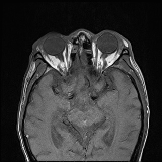 Nasopharyngeal carcinoma with skull base invasion (Radiopaedia 59258-66600 B 5).jpg