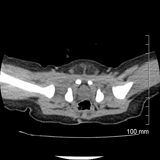 File:Neonatal neuroblastoma (Radiopaedia 56651-63438 Axial non-contrast 80).jpg