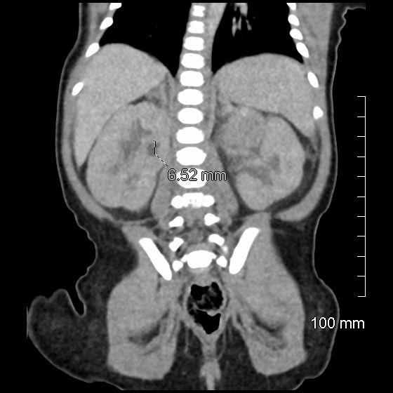 File:Neonatal neuroblastoma (Radiopaedia 56651-63438 Coronal non-contrast 36).jpg