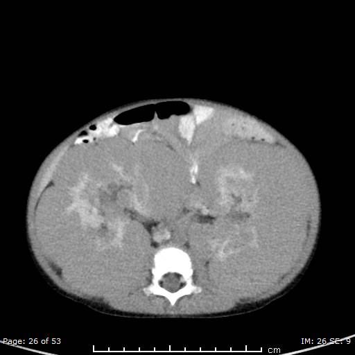 File:Nephroblastomatosis (Radiopaedia 41934-44935 A 26).jpg