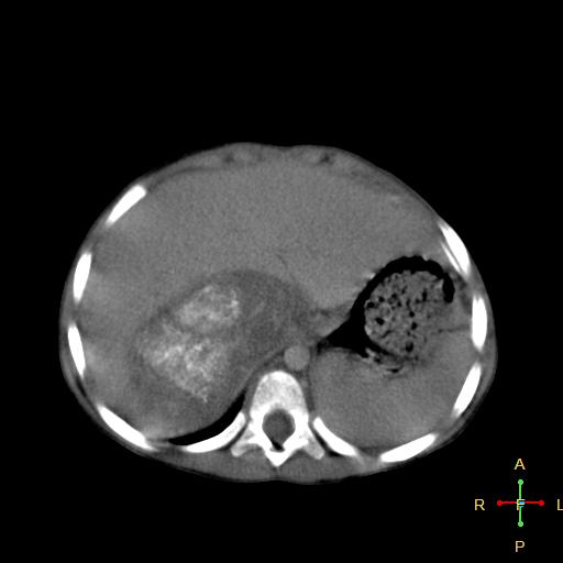 File:Neuroblastoma (Radiopaedia 24751-25016 D 6).jpg