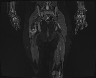 File:Neuroblastoma with bone metastases (Radiopaedia 67080-76414 Coronal STIR 19).jpg