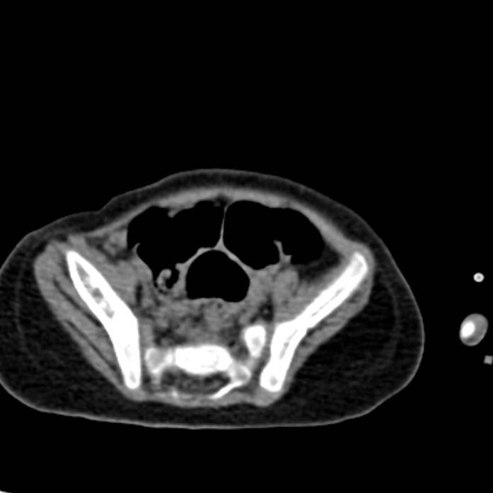 Neuroblastoma with skull metastases (Radiopaedia 30326-30960 Axial non-contrast 49).jpg