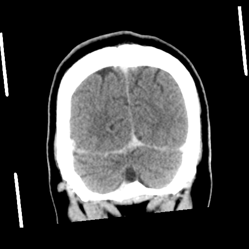 Neurocysticercosis - granular nodular (Radiopaedia 42786-45957 Coronal C+ 55).png