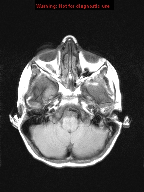 File:Neurofibromatosis type 1 with optic nerve glioma (Radiopaedia 16288-15965 Axial T1 20).jpg