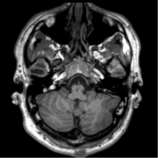 File:Neurofibromatosis type 2 (Radiopaedia 44936-48838 Axial T1 21).png