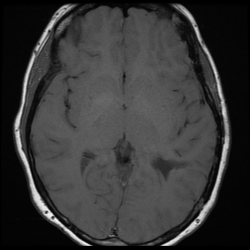 File:Neurofibromatosis type 2 (Radiopaedia 45229-49251 Axial T1 18).png