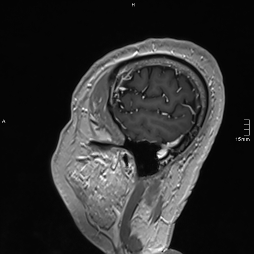 Neurosarcoidosis - involvement of the mesial temporal lobes (Radiopaedia 67429-76820 Sagittal T1 C+ 148).jpg