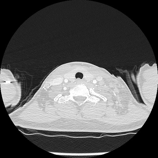 File:Non-small cell lung cancer with miliary metastases (Radiopaedia 23995-24193 Axial lung window 1).jpg
