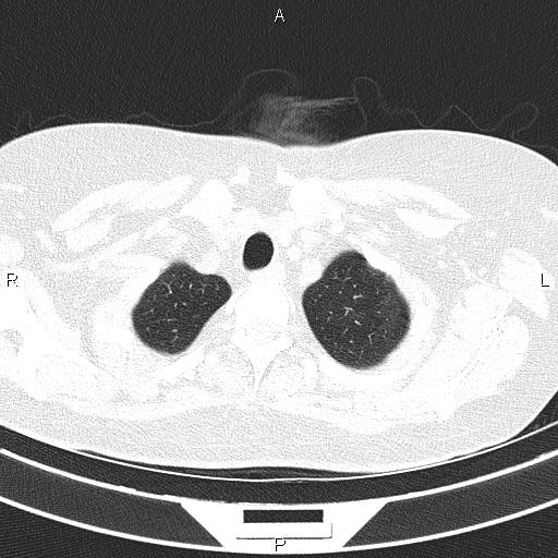 Non-specific interstitial pneumonia (Radiopaedia 83185-97567 Axial lung window 12).jpg