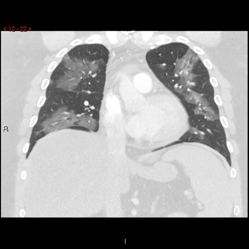 File:Non-specific interstitial pneumonitis (Radiopaedia 27044-27222 Coronal lung window 22).jpg