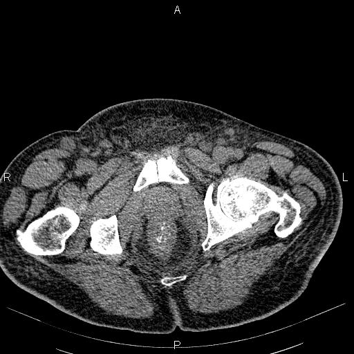 File:Non Hodgkin lymphoma in a patient with ankylosing spondylitis (Radiopaedia 84323-99621 Axial non-contrast 62).jpg