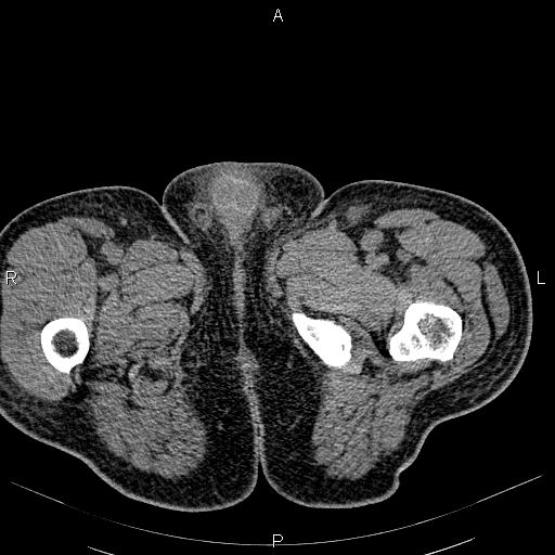 File:Non Hodgkin lymphoma in a patient with ankylosing spondylitis (Radiopaedia 84323-99621 Axial non-contrast 69).jpg