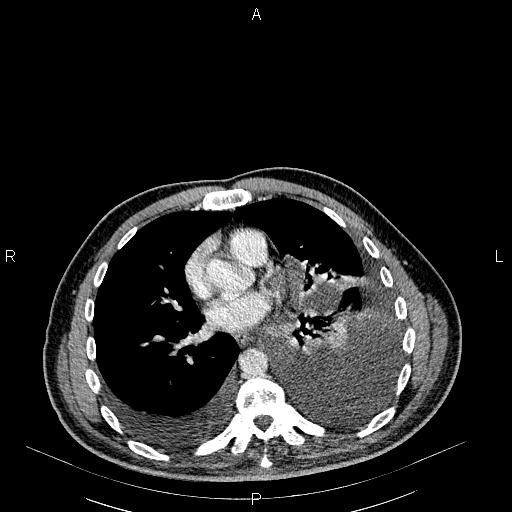 File:Non Hodgkin lymphoma in a patient with ankylosing spondylitis (Radiopaedia 84323-99621 B 20).jpg