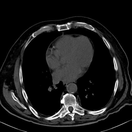 File:Normal CT intravenous cholangiogram (Radiopaedia 38199-40208 Axial IVC 1).png