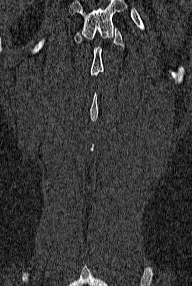 Normal CT lumbar spine (Radiopaedia 53981-60118 Coronal bone window 67).jpg