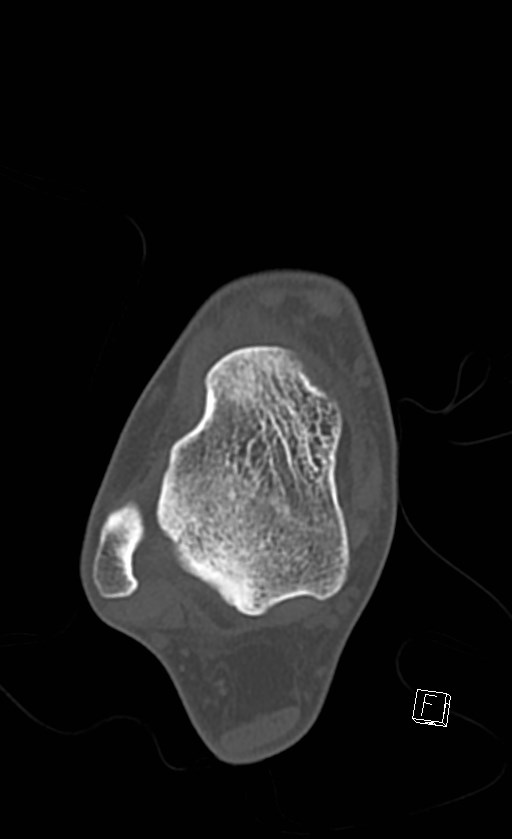 Normal CT of the ankle (Radiopaedia 47111-51658 Axial bone window 51).jpg