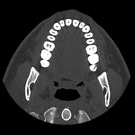Normal CT paranasal sinuses (Radiopaedia 42286-45390 Axial bone window 111).jpg