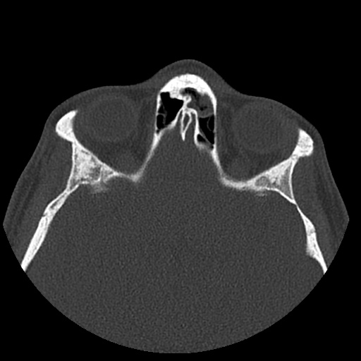 Normal CT paranasal sinuses (Radiopaedia 42286-45390 Axial bone window 36).jpg