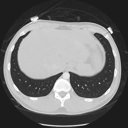 Normal CT pulmonary veins (pre RF ablation) (Radiopaedia 41748-44702 Axial lung window 61).png