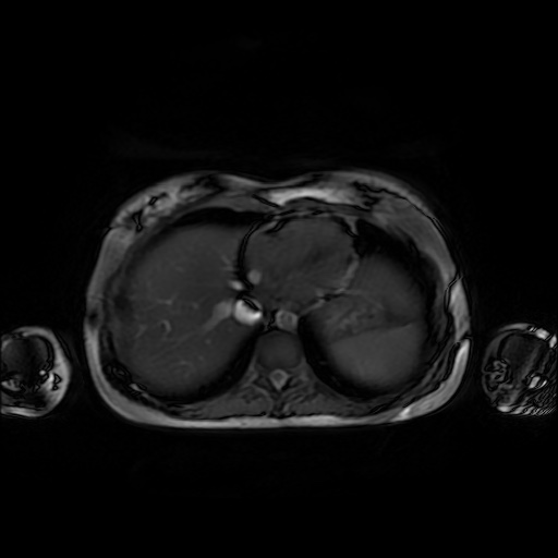 File:Normal MRI abdomen in pregnancy (Radiopaedia 88001-104541 Axial Gradient Echo 5).jpg