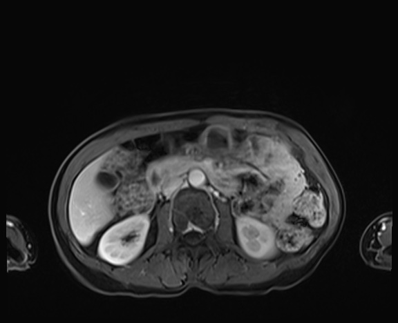 Normal adrenal glands MRI (Radiopaedia 82017-96004 K 44).jpg