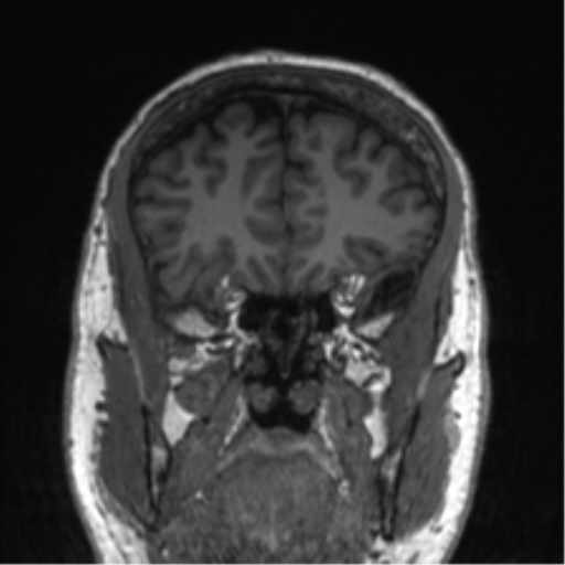 Normal brain MRI (non-focal epilepsy protocol) (Radiopaedia 53917-60040 Coronal T1 50).png
