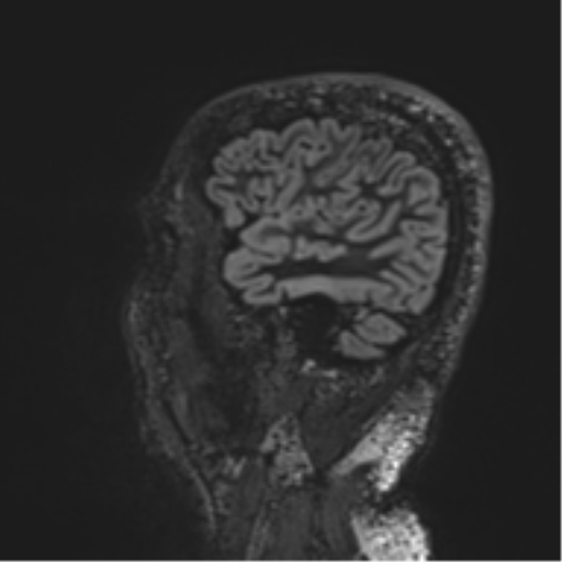 Normal brain MRI (non-focal epilepsy protocol) (Radiopaedia 53917-60040 Sagittal DIR 51).png