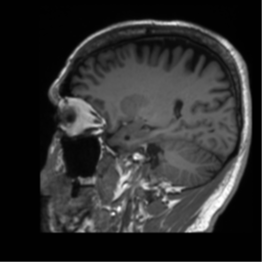 Normal brain MRI (non-focal epilepsy protocol) (Radiopaedia 53917-60040 Sagittal T1 21).png