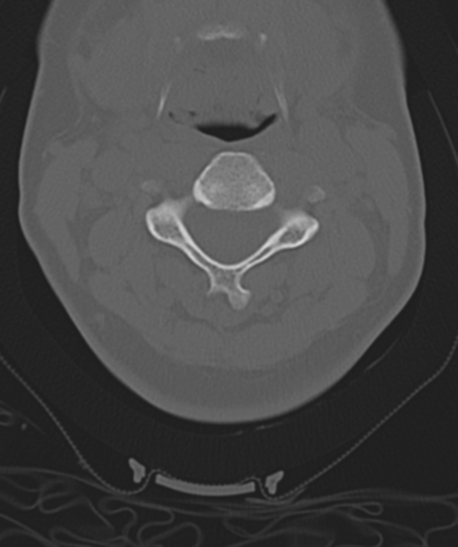 Normal cervical spine MRI (including Dixon) (Radiopaedia 42762-45926 Axial bone window 24).png