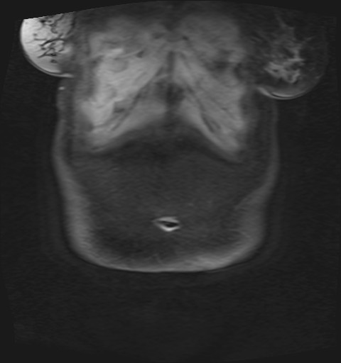 File:Normal hepatobiliary phase liver MRI (Radiopaedia 58968-66230 B 52).jpg