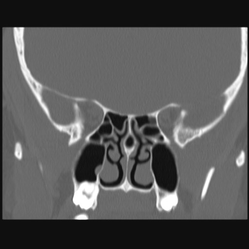 Normal sinus CT (annotated) (Radiopaedia 78917-91810 Coronal bone window 36).jpg