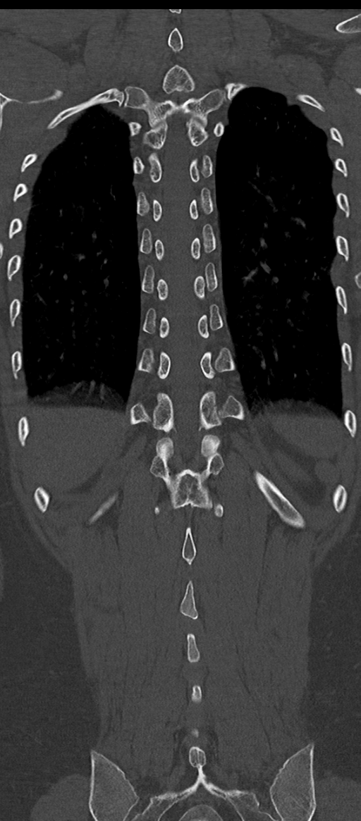 Normal thoracolumbar spine (Radiopaedia 43822-47309 Coronal bone window 70).png