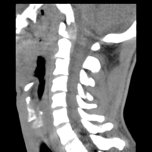 File:Normal trauma cervical spine (Radiopaedia 41017-43760 B 17).png