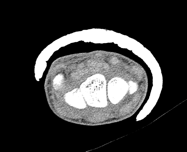 Normal wrist CT (Radiopaedia 41425-44297 Axial non-contrast 33).png